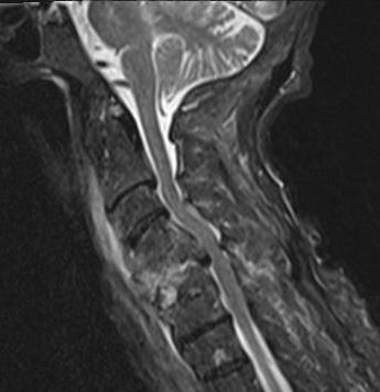 Cervical osteomyelitis